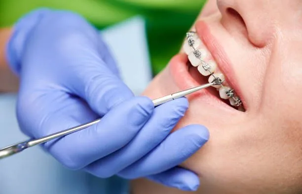 Braces & Aligners in Varanasi