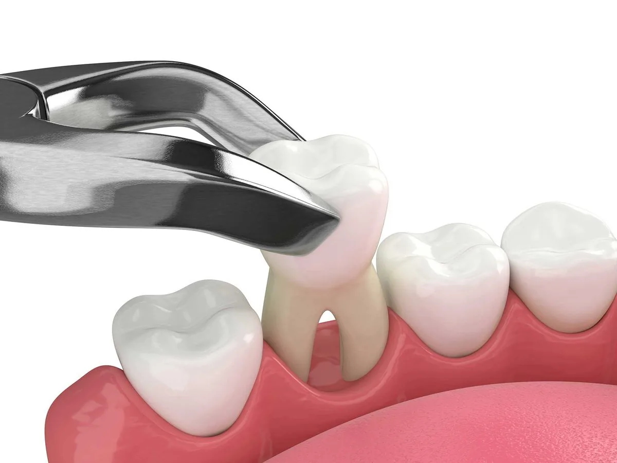 Tooth Extraction in Varanasi